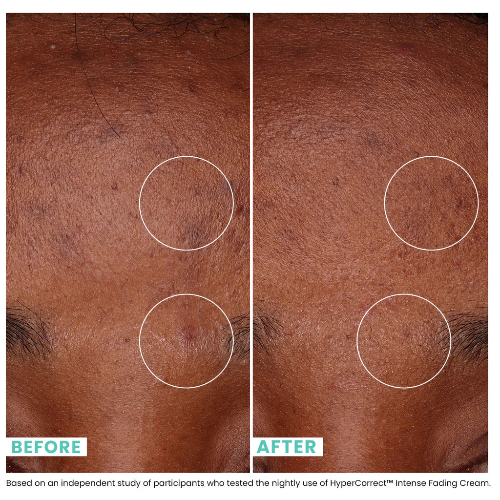 HyperCorrect™ Intense Fading Cream