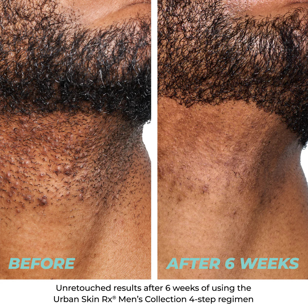 Razor Bump + Dark Spot Treatment